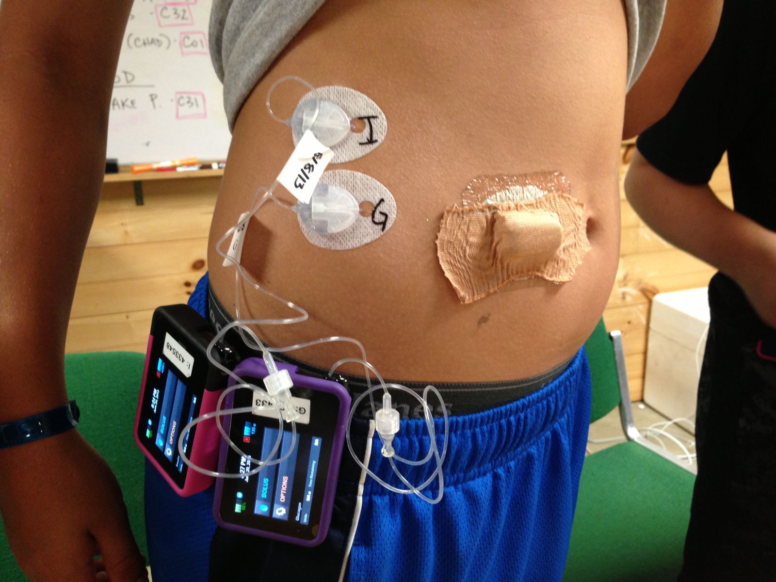 bionic pancreas 