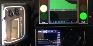 DiAs system, artificial pancreas