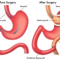Metabolic surgery, bariatric surgery