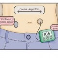 Automated Insulin Delivery