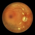 Eye scan showing diabetic retinopathy