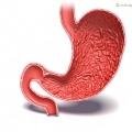 Gastroparesis